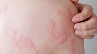 Thường xuyên nổi mày đay có phải do suy giảm chức năng gan?