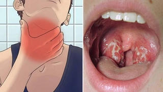 Dấu hiệu cảnh báo lây nhiễm vi khuẩn bạch hầu