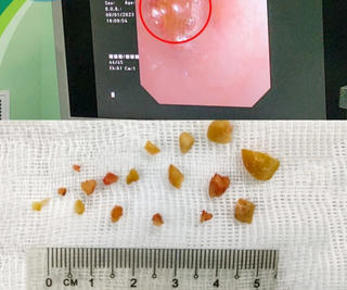 Dịp Tết, đề phòng trẻ hóc các loạt hạt dưa, hạt bí, hạt lạc