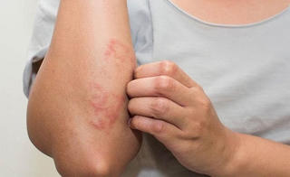 Đề phòng viêm da cơ địa khi giao mùa