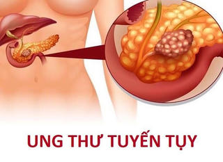 Nguy cơ ung thư tụy cao gấp 16 lần khi viêm tụy mạn