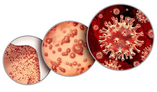 84% ca bệnh đậu mùa khỉ thuộc nhóm nam quan hệ tình dục đồng giới