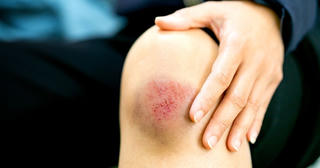 Không chủ quan với vết thương ngoài da