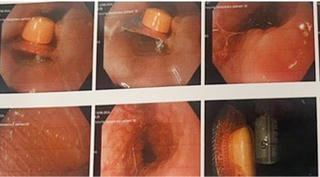 Nhập viện vì viên thuốc còn nguyên vỏ cắm sâu vào thực quản