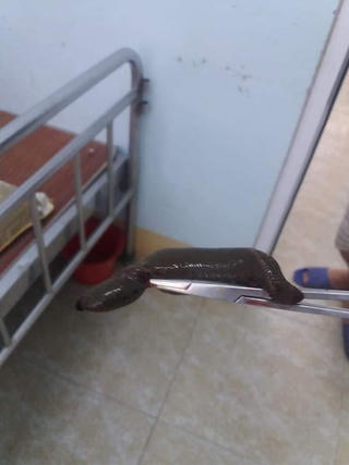 Xử lý thành công con đỉa dài 15cm chui vào bộ phận sinh dục của cụ ông hơn 70 tuổi