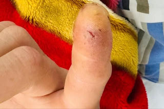 Mẩn ngứa, tê bì toàn thân sau khi bị cu li cắn