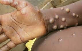 Ca bệnh đậu mùa khỉ đầu tiên của Việt Nam được phát hiện sau chuyến du lịch Dubai