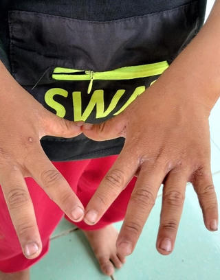 Quảng Nam: Phát hiện 69 học sinh mắc bệnh ghẻ