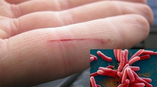 Gi nhận 3 ca bệnh Whitmore, Bộ Y tế khuyến cáo chủ động phòng tránh