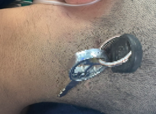 Nam sinh chấn thương sọ não do chìa khóa cắm sâu vào đầu