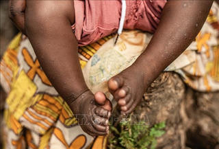 WHO tiếp tục cảnh báo nguy cơ từ bệnh đậu mùa khỉ tại châu Phi