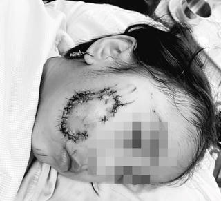 Cháu bé 5 tuổi bị chó cắn phải khâu gần 50 mũi