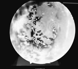 Gắp ra nhiều ‘ve rận’ từ tai bệnh nhi 6 tuổi