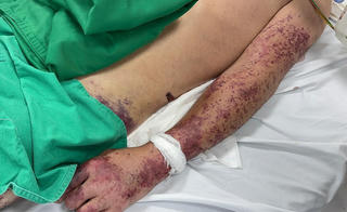 Chế biến thủ lợn, một người đàn ông nguy kịch vì khuẩn liên cầu lợn