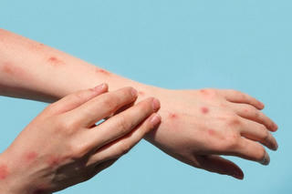Ca nghi mắc đậu mùa khỉ ở Đắk Lắk có kết quả xét nghiệm âm tính