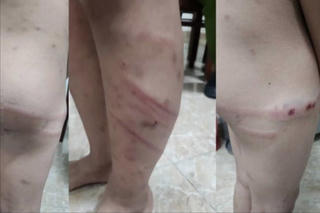 Phú Thọ: Làm rõ nghi vấn bé trai 11 tuổi bị mẹ ruột và bạn trai bạo hành
