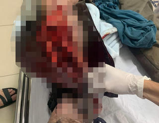 Hải Phòng: Nổ khí thùng phuy dầu khiến một người bị trọng thương