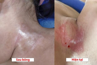 Cảnh báo bỏng hoá chất từ chất tẩy dầu mỡ