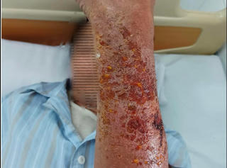 Hà Nội: Cụ ông mắc căn bệnh nhiễm trùng nguy hiểm sau vết xước vì mèo cào