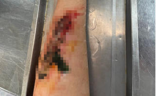 Tự đắp lá thuốc vào vết thương, nam thanh niên suýt hoại tử cánh tay