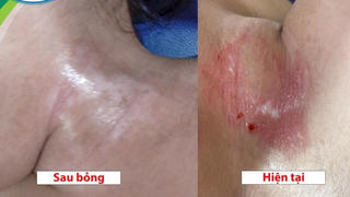 Cảnh báo bỏng hóa chất từ dầu mỡ