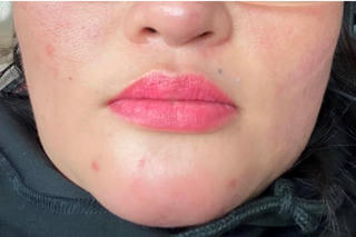 Nhiều trường hợp biến chứng sau tiêm filler: Bác sĩ đưa cảnh báo về những thẩm mỹ "chui"