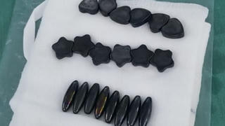 Bé trai nuốt 20 viên nam châm phải cắt bỏ 1 đoạn ruột