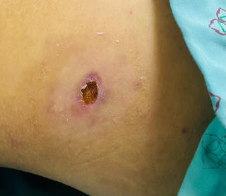 Nguy cơ sốt mò gia tăng trở lại