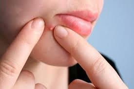 Cảnh báo biến chứng nguy hiểm từ thói quen nặn mụn