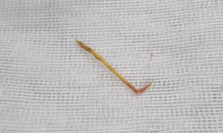 Một bệnh nhân bị thủng ruột do nuốt xương cá