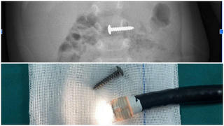 Gắp thành công chiếc đinh vít ra khỏi bụng bệnh nhi 34 tháng tuổi