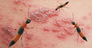 Xử lý đúng cách viêm da do tiếp xúc kiến ba khoang