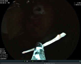 Người đàn ông bị mảnh xương cá 2,5 cm găm sâu vào gốc lưỡi