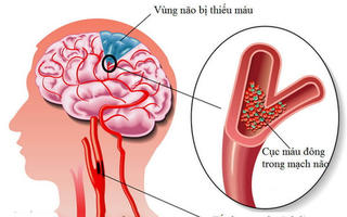 Phân biệt đột quỵ và co giật