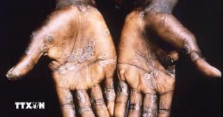 Ca mắc bệnh đậu mùa khỉ ở Pakistan không liên quan chủng virus mới