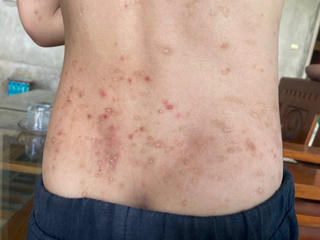 Xác định được loại côn trùng 'lạ' khiến hàng trăm người ở Hà Tĩnh bị viêm da dị ứng