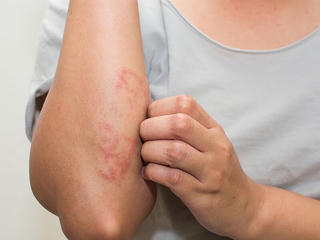 Các bệnh ngoài da phát triển mạnh vào mùa nắng, oi bức