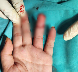 Đà Nẵng: Phẫu thuật thành công nối ngón 4 bàn tay cho bệnh nhân