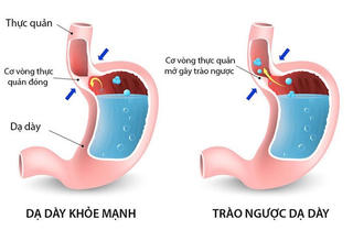 Bệnh trào ngược dạ dày - thực quản: 5 biến chứng nguy hiểm
