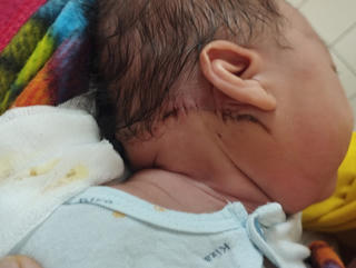 Điều trị thành công bệnh nhi sơ sinh mắc khối u máu khổng lồ hiếm gặp 