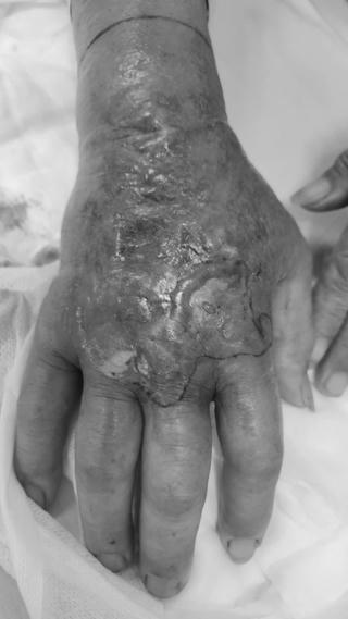 Nhiều bệnh nhân nhập viện do rắn và động vật cắn sau bão Yagi