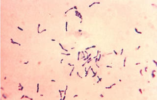 Bệnh bạch hầu nguy hiểm ra sao?