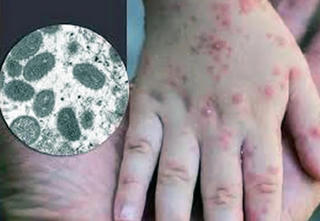 Cà Mau ra văn bản khẩn tăng cường phòng chống bệnh Đậu mùa khỉ