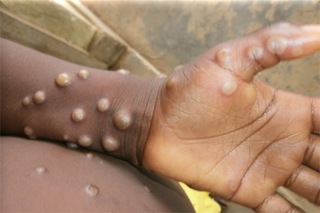 Ứng phó với bệnh đậu mùa khỉ