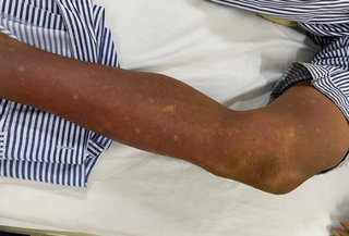 Biến chứng nặng ở người bệnh đái tháo đường mắc sốt xuất huyết