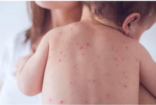 Hà Nội: Ghi nhận ca mắc rubella đầu tiên trong năm 2024