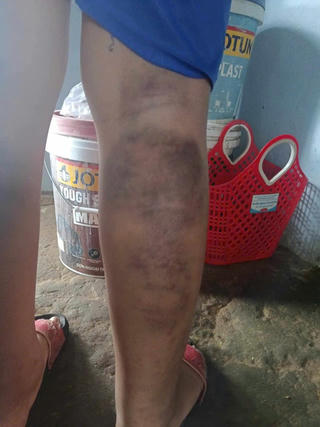 Quảng Nam: Cảnh cáo giáo viên chủ nhiệm đánh học sinh bầm tím 2 chân