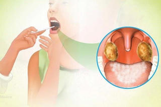 Bắc Giang phát hiện nữ sinh mắc bệnh bạch hầu do tiếp xúc ca tử vong ở Nghệ An