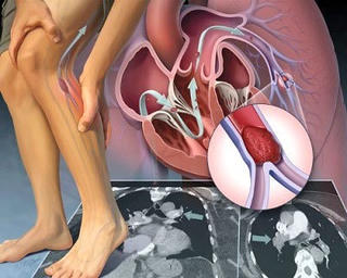 Tắc động mạch chi dưới vì hút thuốc lá