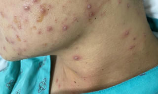 Cảnh giác bệnh thủy đậu 'vào mùa'